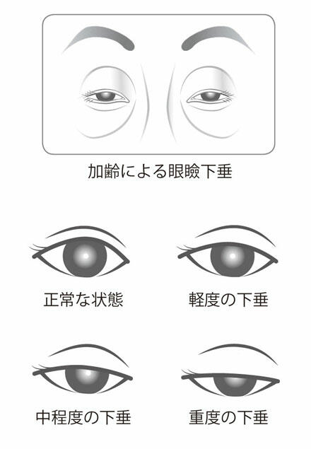 加齢による眼瞼下垂,正常な状態,軽度の下垂,中程度の下垂,重度の下垂