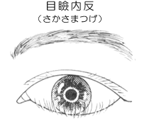 4 乳児の場合 よくみられる症状と病気 赤ちゃんの目の病気 目についての健康情報 公益社団法人 日本眼科医会