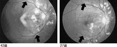 高血圧性網膜症の合併症