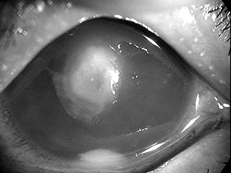 緑膿菌による角膜感染の写真