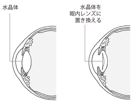 4 眼内レンズの働き 白内障手術と眼内レンズ 眼内レンズを上手に選ぶために 目についての健康情報 公益社団法人 日本眼科医会