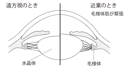 7 単焦点眼内レンズと多焦点眼内レンズ 白内障手術と眼内レンズ 眼内レンズを上手に選ぶために 目についての健康情報 公益社団法人 日本眼科医会