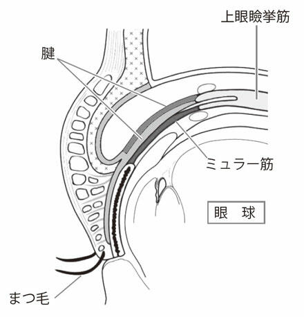 6 眼瞼下垂の手術 1 まぶたを上げる筋肉の付着部の強化 修復 眼瞼下垂に悩むかたへ 目についての健康情報 公益社団法人 日本眼科医会