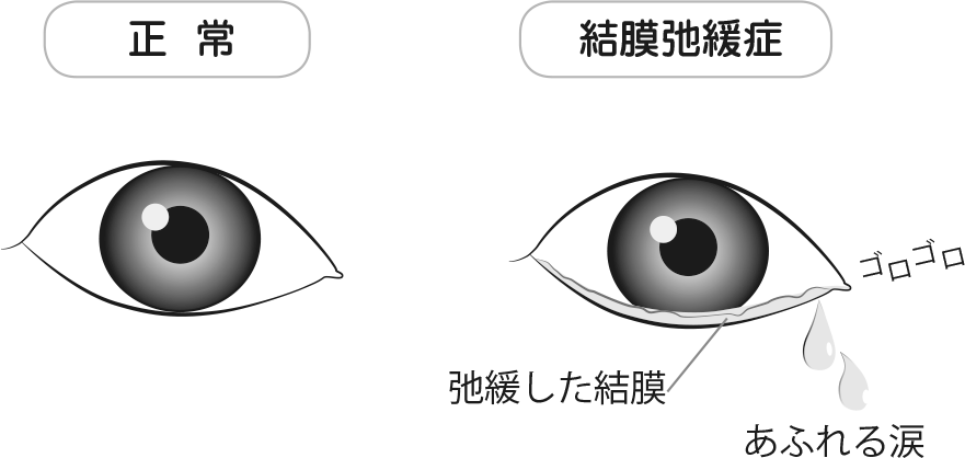 正常の目と結膜弛緩症の目